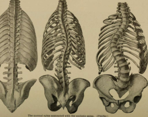 Understanding Surgical Options for Spinal Deformities