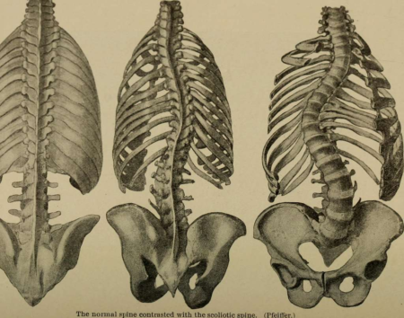 Understanding Surgical Options for Spinal Deformities