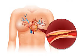 Coronary Artery Disease: Not Just a Man’s Disease