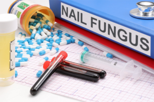 How to Spot Nail Fungus Before It Spreads