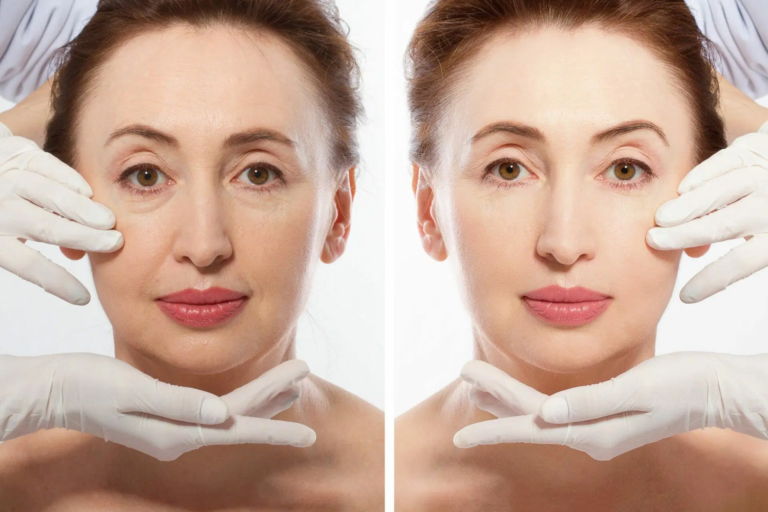 How to Decide Between a Traditional and Mini Face Lift