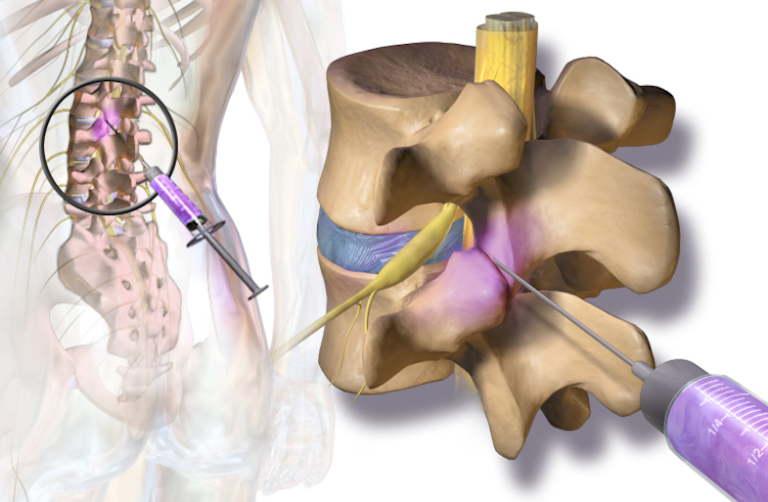 When to Consider Facet Joint Injections for Osteoarthritis