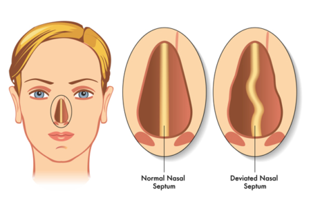 Common Causes and Treatments for Nasal Breathing Disorders