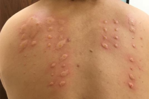 How Allergy Testing Can Help Identify Hidden Triggers