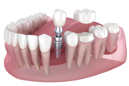 The Differences Between Dental Implants and Veneers