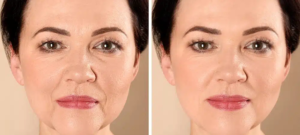 How Skin Tightening Treatments Restore Youthful, Firm Skin