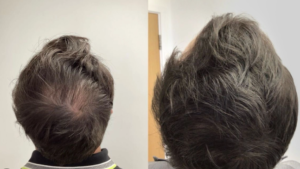 Using PRP for Hair Restoration: What You Should Know